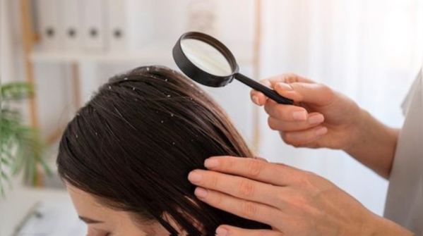 How to use mint for dandruff and a greasy scalp?