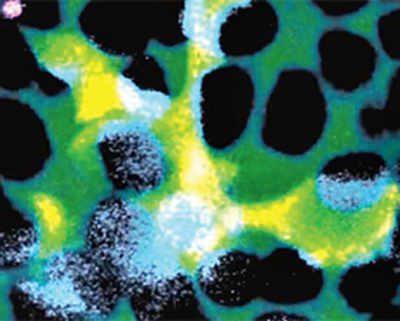 Human scavenger cells could accelerate blinding eye diseases