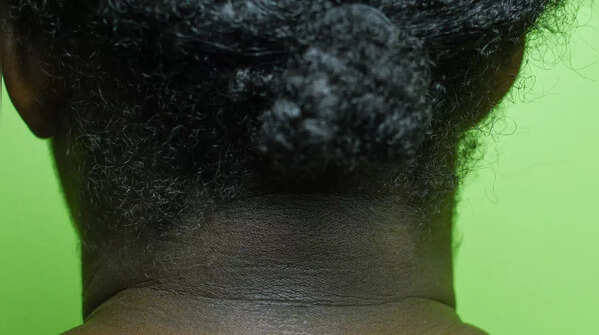 Darkened skin