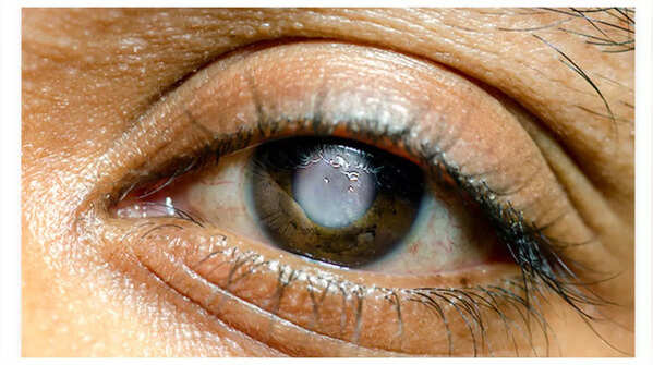 Glaucoma