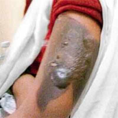 Powai woman scalds 13-yr-old domestic help with hot iron