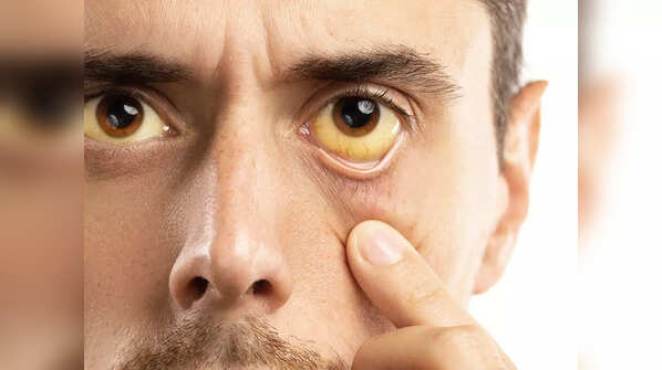 Other symptoms of liver problems