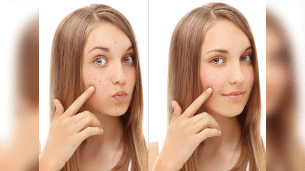 How To Heal Acne Scars