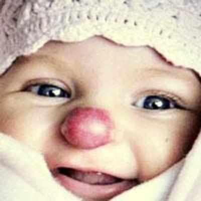 Operation ends '˜clown nose' birthmark misery of girl, 3