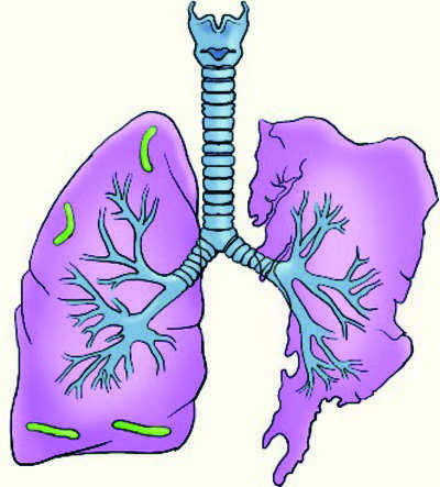 Report Tuberculosis  cases, get incentives