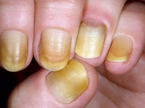 What the texture and colour of your nails can tell you about your health