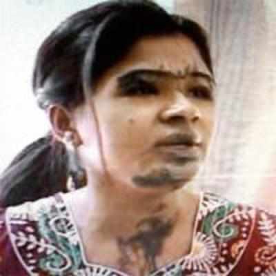 Goregaon acid attack victim struggles to fund surgeries