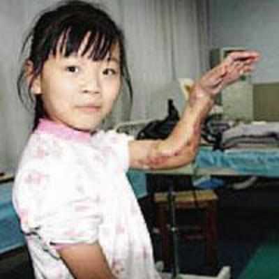Docs save girl's hand by grafting it on leg