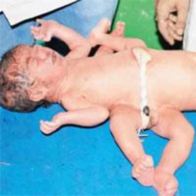 Bengal stunned by Siamese twins, docs say only one will live