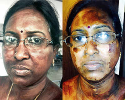 Woman loses face to facial