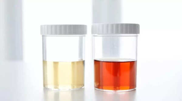Dark urine and pale stools