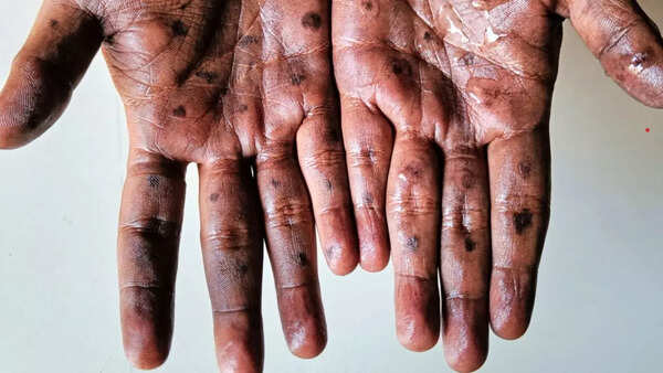 Can Mpox become the new Covid? Here's how the infection is spreading in the current outbreak