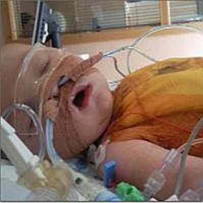 What is congenital lung malformations?