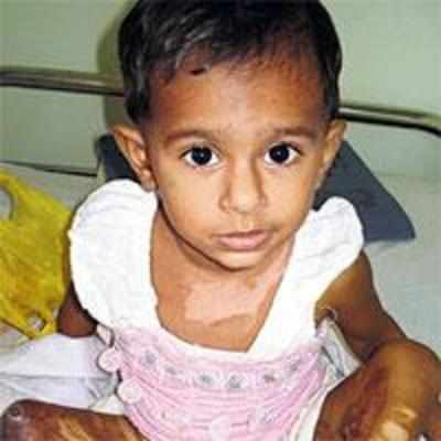 Docs separate 2-yr-old's calves joined by burns to back of her thighs