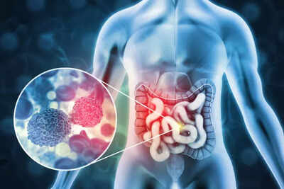 Bowel cancer: One of the earliest signs of colorectal (bowel) cancer includes a recent change in bowel habits