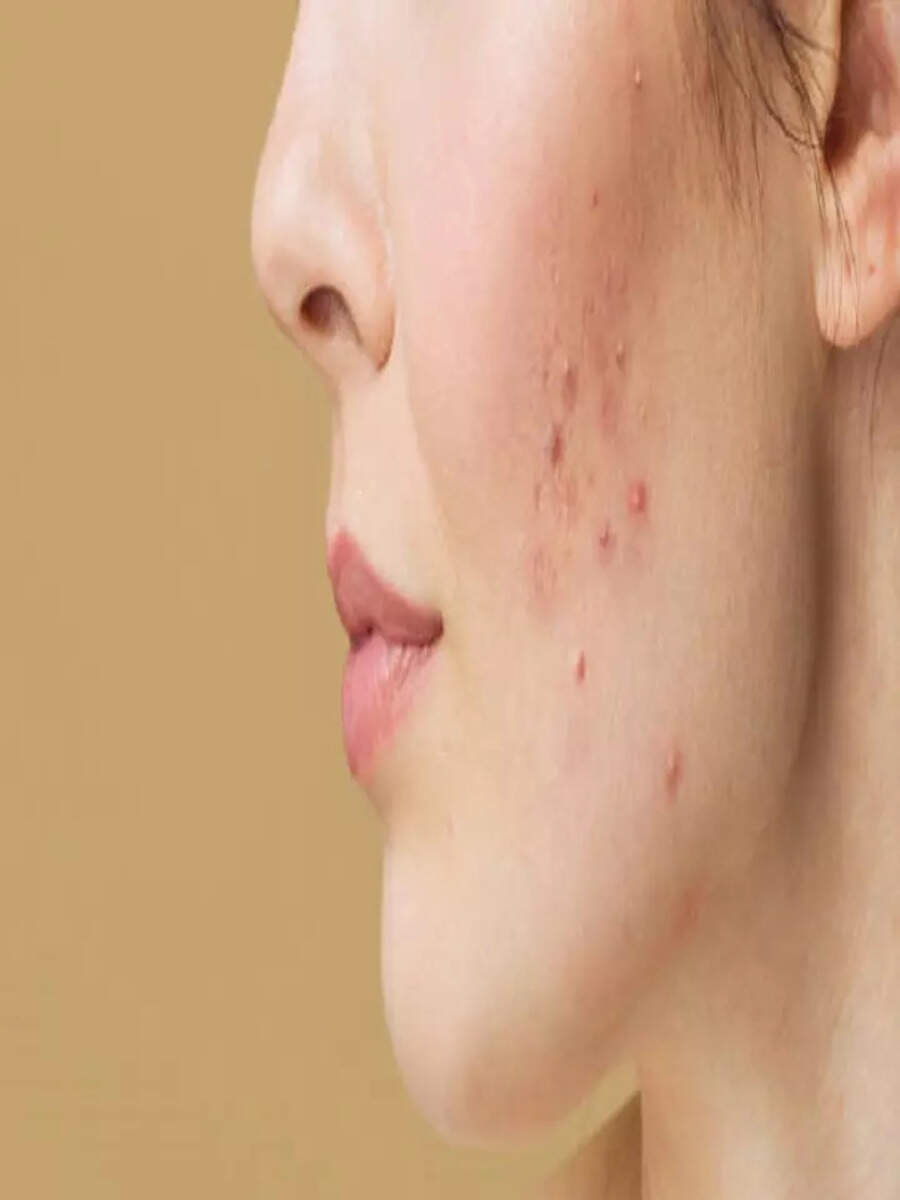 10 Natural ways to prevent acne and pimple on face Times Now