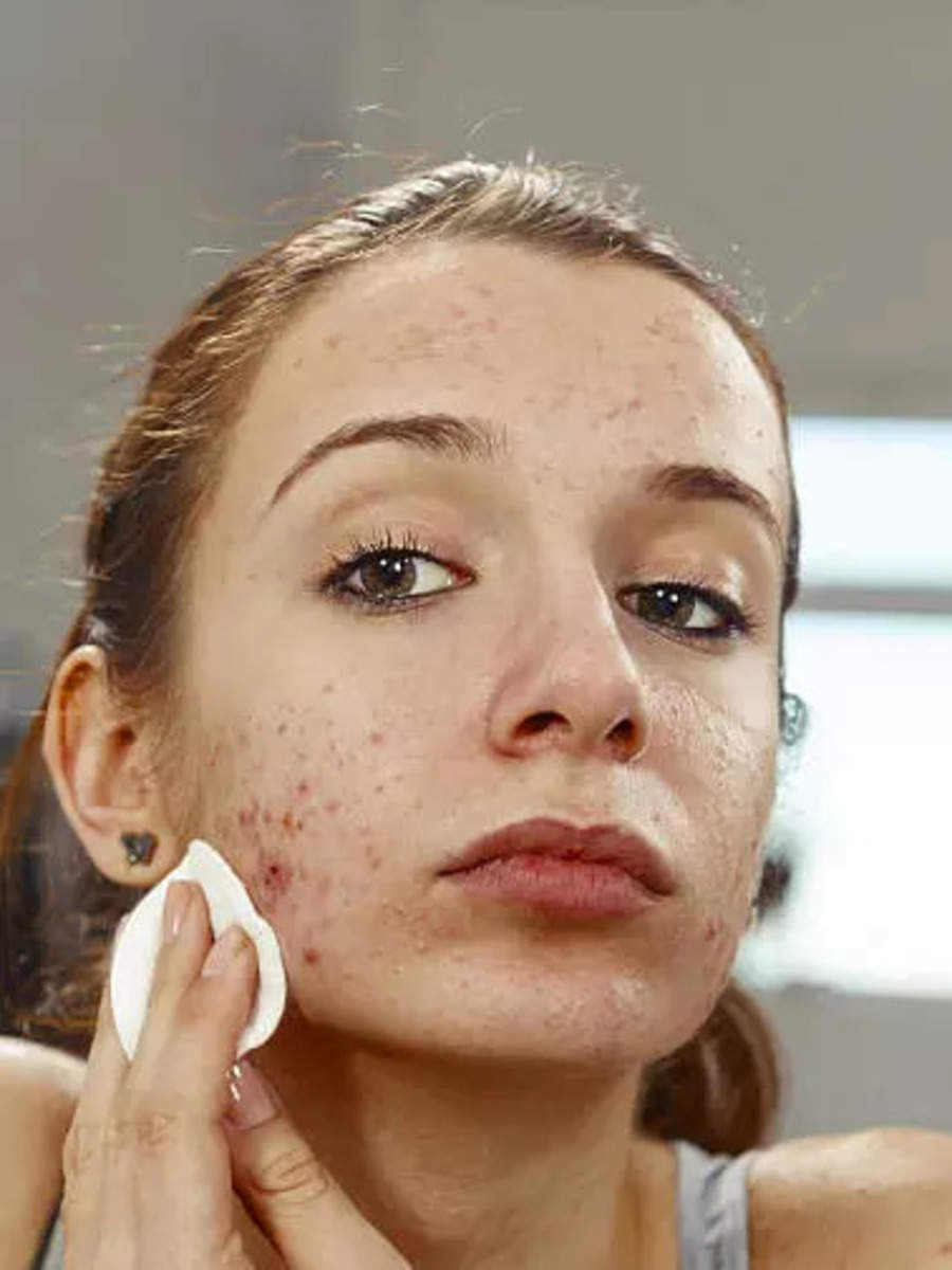 get rid of pimples fast home remedies