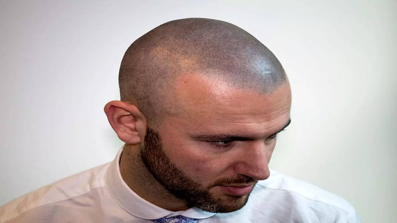 Derek Ramsay gets hyper realistic scalp tattoo | GMA News Online