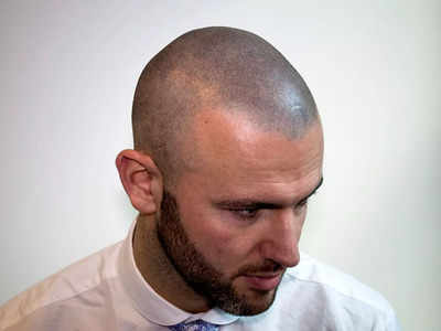 Scalp Micropigmentation Hair Tattoos Give Balding Men New Hair Hope