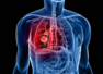 Lung cancer risk among non-smokers