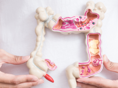 Spike in colorectal cancer in young patients