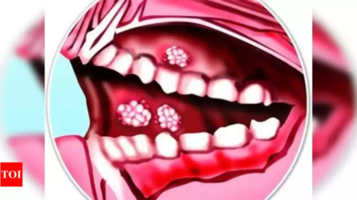 Oral cancer 26% in Nagpur, surpasses national average of 10%: Data