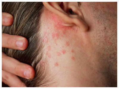 How to know if your skin rash is eczema