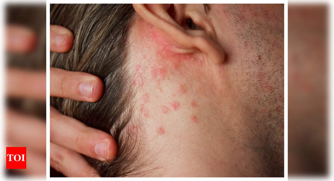 Heat Rash vs. Eczema: Photos, Causes, Treatment