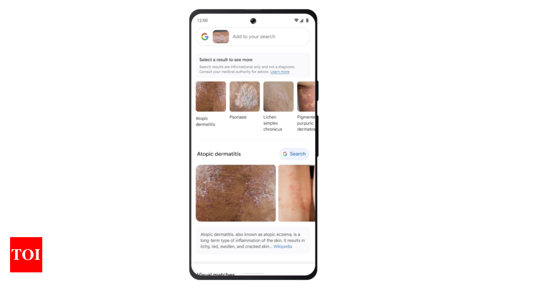 Google: Google will now help you identify skin conditions and rashes, here’s how – Times of India