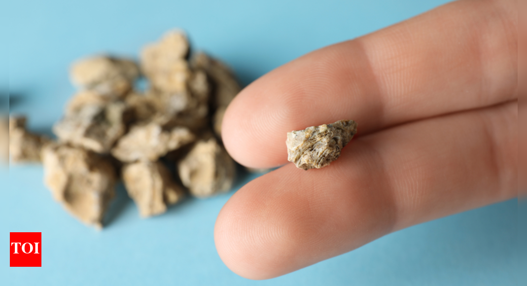 Man wins Guinness World Record for world's largest kidney stone Times