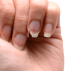 Nails in nutritional deficiencies - Indian Journal of Dermatology,  Venereology and Leprology