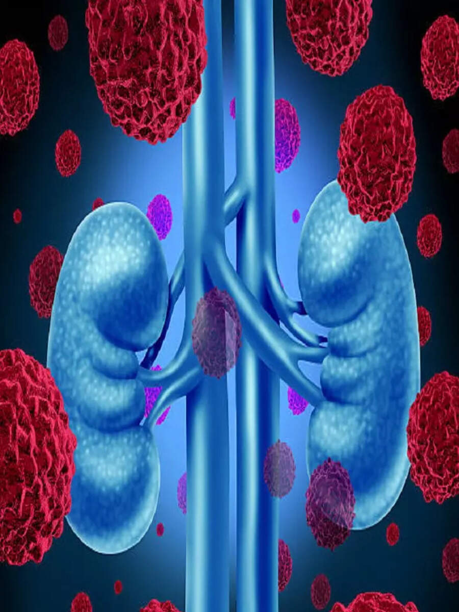 9-early-signs-and-symptoms-of-kidney-cancer-times-now