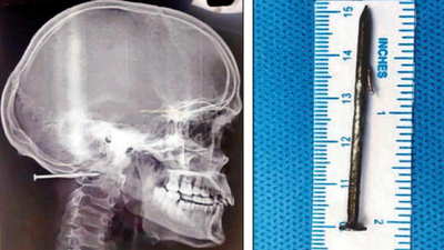 Man shoots nail into brain and thinks nothing of it | US news | The Guardian