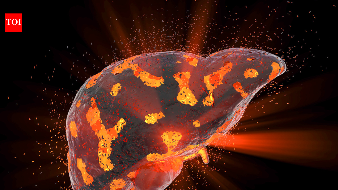 Fatty Liver Causes: 5 common causes of fatty liver, according to the ...