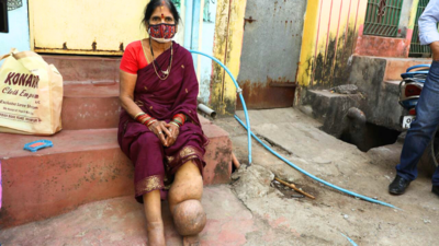 Elephantiasis in India: Disfiguring disease caused by mosquito bite