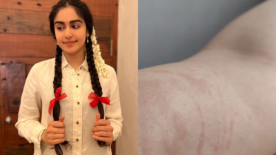 Adah Sharma updates fans on having hive, talks about the "horrible rash": Know details