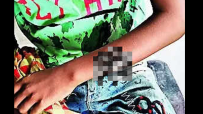 Odisha: Parents brand 12-year-old son with hot iron rod for 'skipping' school, held