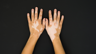 Indian-origin researcher identifies new genes responsible for pigmentation; could help in developing drugs for vitiligo & other diseases