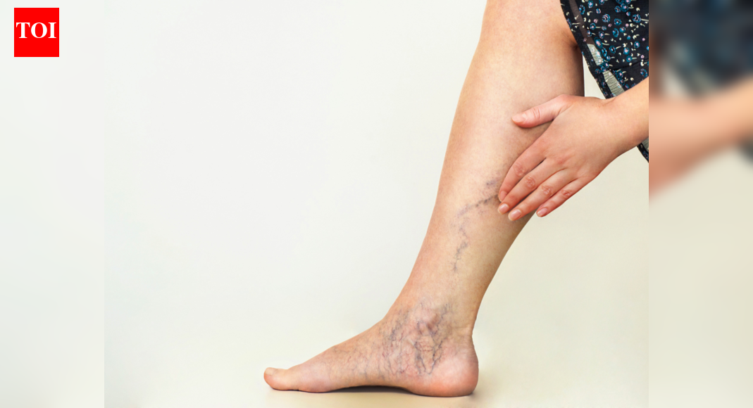 Unusual case of 'blue legs' in long COVID patient seen; Here’s what an ...