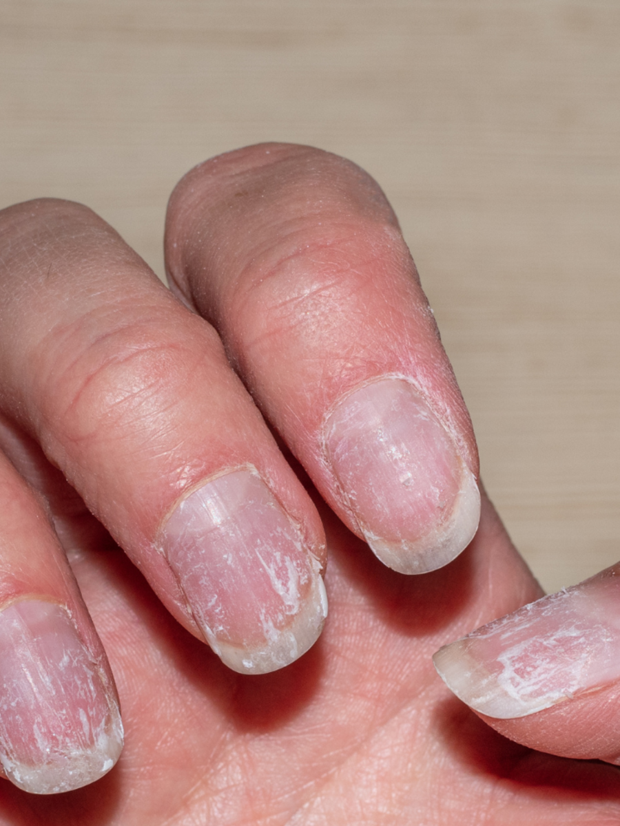 8-diseases-that-white-spots-on-your-nails-indicate-times-of-india