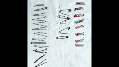 13 hairpins, 5 safety pins, 5 razor blades removed from Puducherry man's  belly
