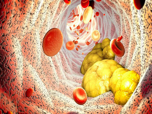 High cholesterol symptoms: THIS lesser-known sign could strike in