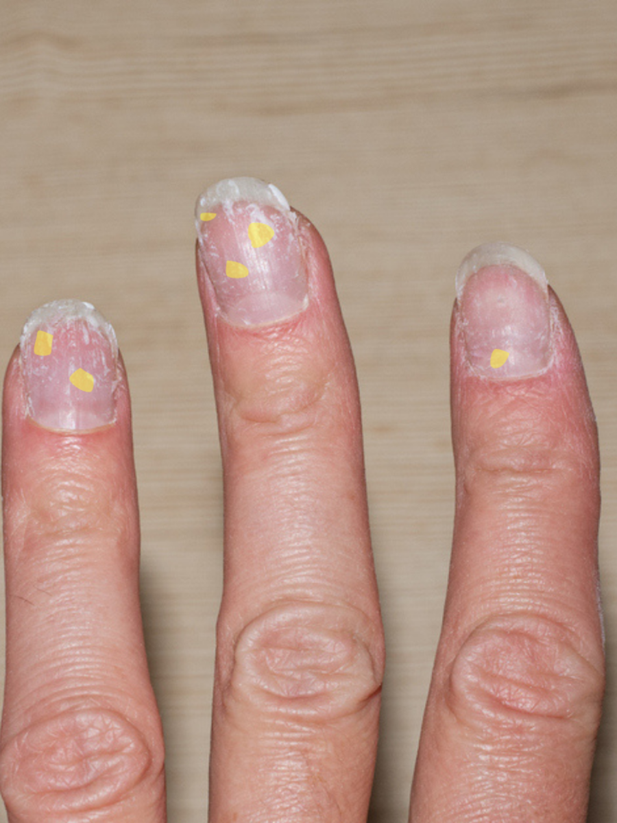 10 Fingernail Problems You Should Not Ignore | OnlyMyHealth