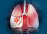5 common warning signs of lung disease