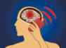 Can mobile radiation cause brain tumors?