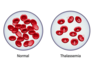 ​Thalassemia: Here’s all you need to know 