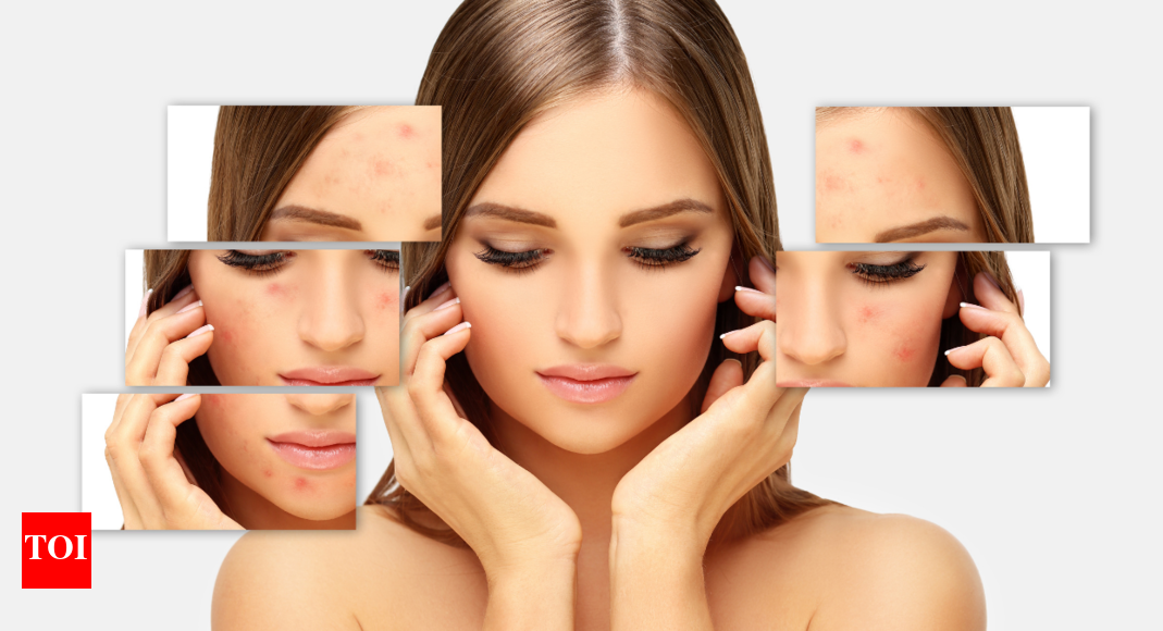 Scar Cream For Face Options to Heal and Soothe Your Skin Times of