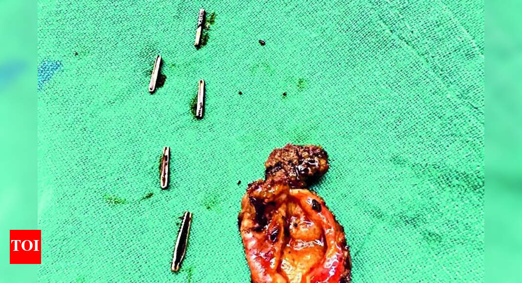 Surgery Docs Left 5 Clips In Gallbladder 5 Yrs Ago, Removed Jaipur