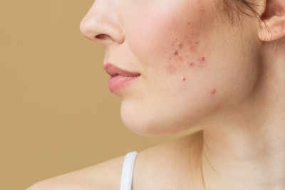 ​Understanding Acne: Myths, facts, and treatment options