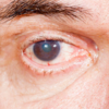 High cholesterol symptoms in eyes - AHKTRIO
